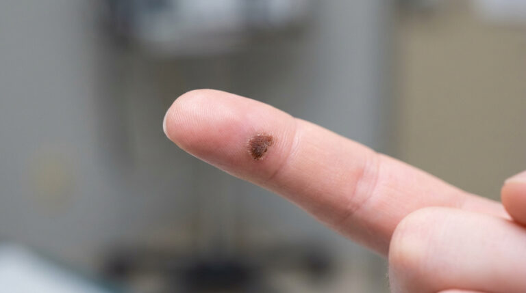 Gros plan d'une verrue brune et croûteuse sur l'index d'une personne, indiquant une possible nécrose ou guérison.