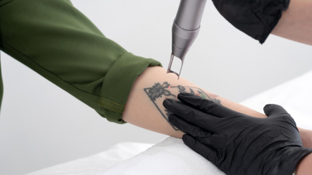 Quel centre de détatouage laser choisir à Toulouse ?