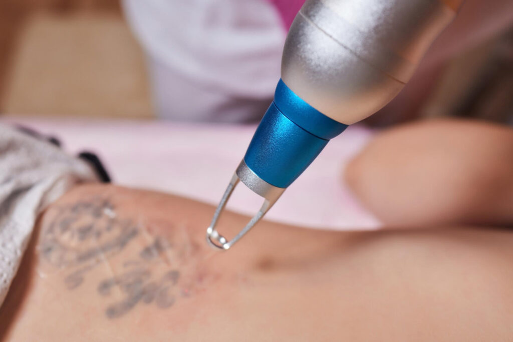 Jeune femme subissant une procédure de détatouage au laser dans un salon en gros plan