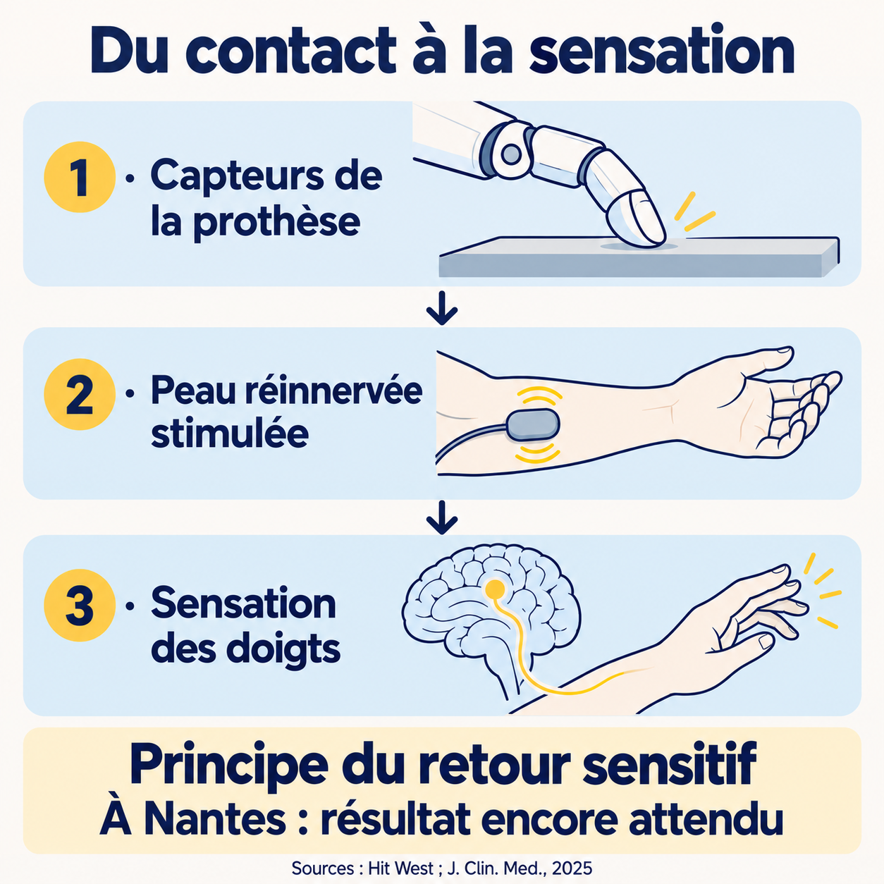 Schéma du trajet sensitif : capteurs de la prothèse, stimulation de la peau réinnervée, puis perception dans les doigts absents ; résultat encore attendu à Nantes.